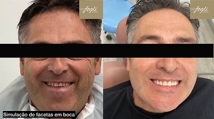 Detalhe de facetas cerâmicas